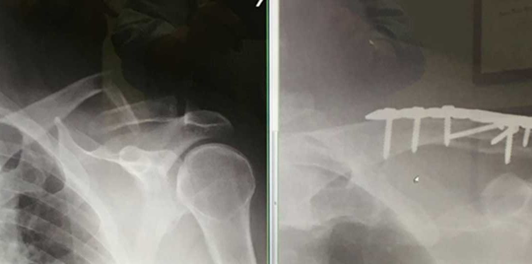 ¡Me Fracturé la Clavícula!
